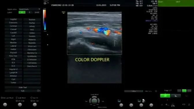 Hip Effusion on Ultrasound, boy 5years