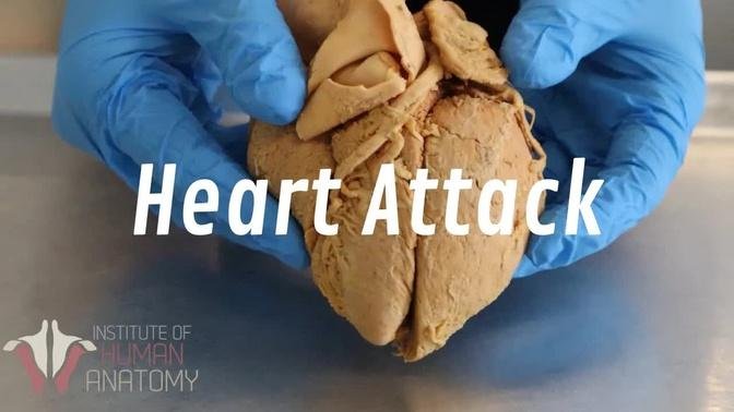 What Happens During a Heart Attack  Anatomy of a Heart Attack