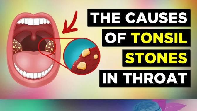 the-real-cause-of-tonsil-stones-and-treatment