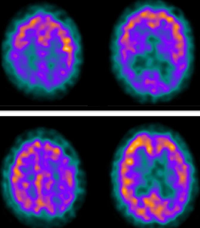 Single-Photon Emission Computed Tomography